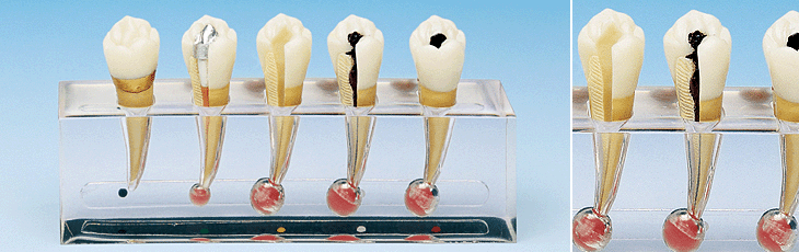 牙髓病临床模型