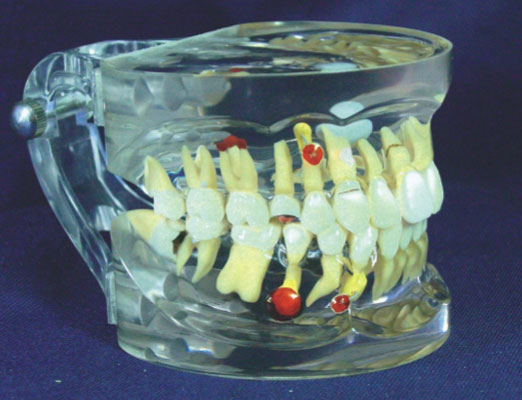 透明牙体综合病理模型